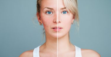 dieta care combate rozaceea